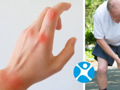 Artrite e osteoartrite differenze e cure